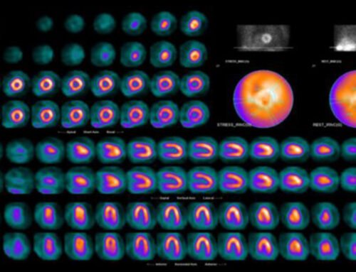 ECG’s AVR ST elevation Analysis by Perfusion Scintilography in the Context of Myocardial Ischemia